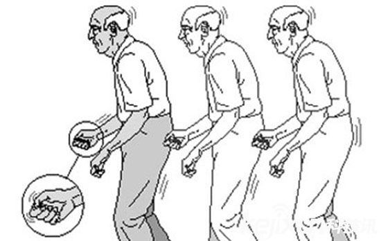 智能穿戴在醫(yī)學上的擴展 帕金森癥用智能穿戴緩解